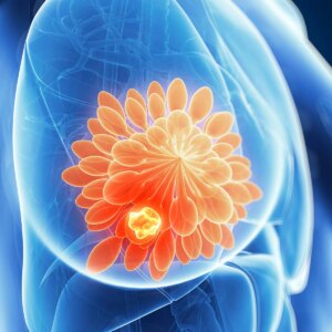 Read more about the article Some Breast Cancer Patients May Safely Forgo Chemotherapy