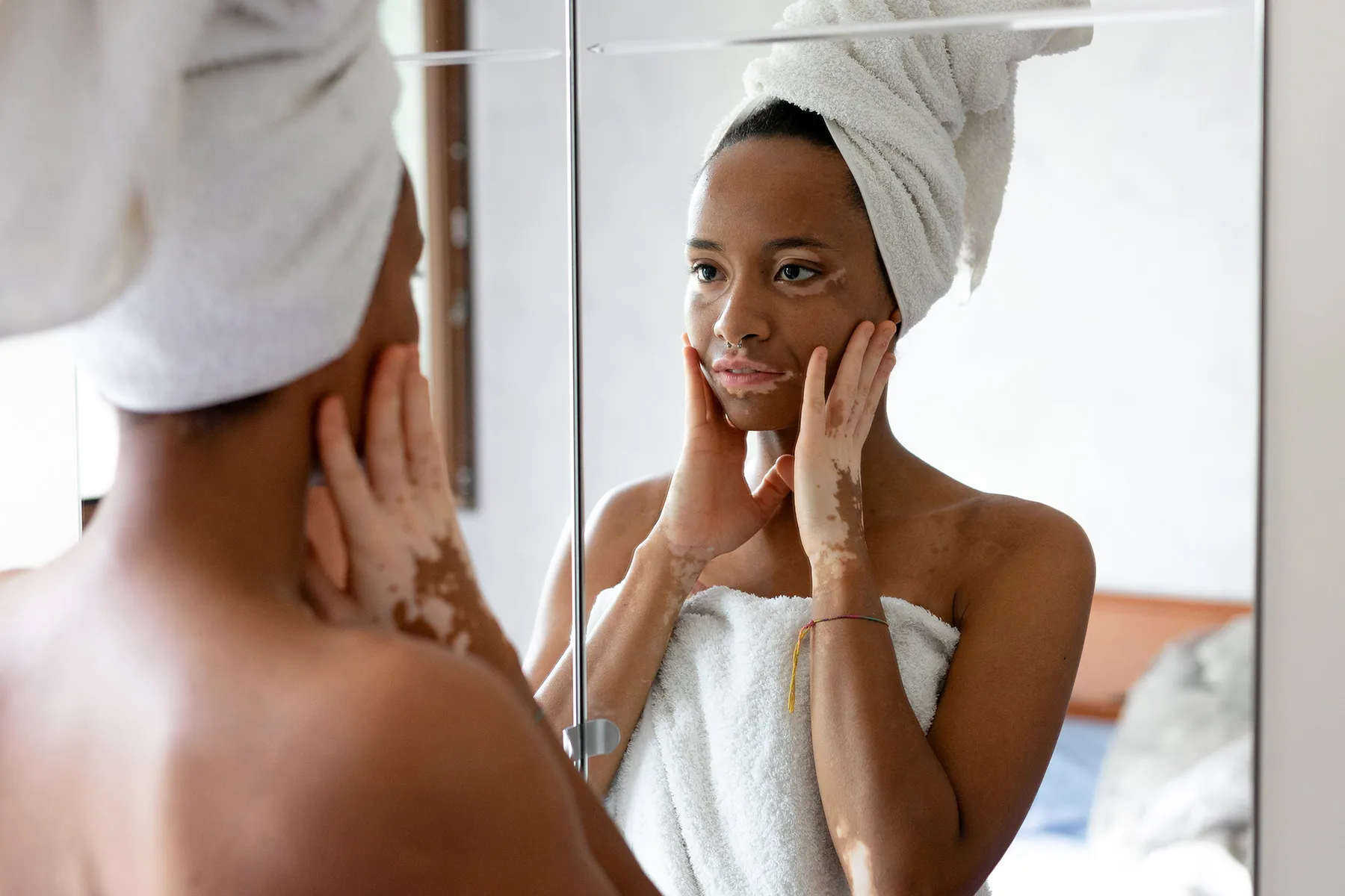 You are currently viewing Vitiligo: Learning to Love My New Look