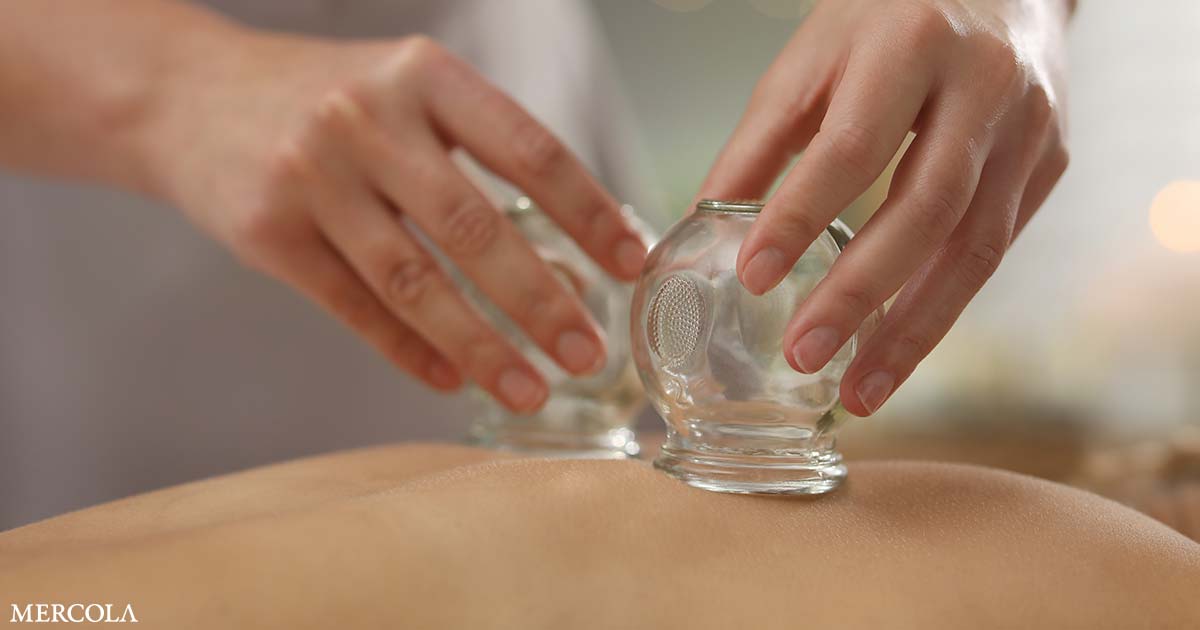 You are currently viewing Exploring the Benefits of Cupping Therapy